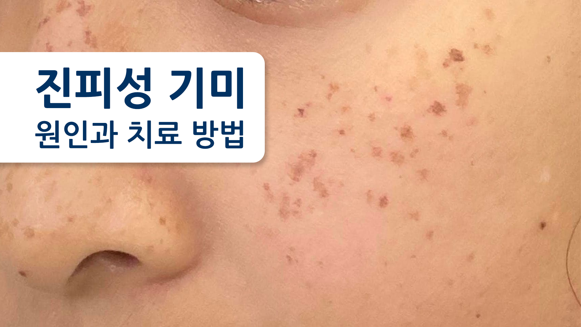 기미(진피성 기미)는 완전히 치료할 수 있을까?