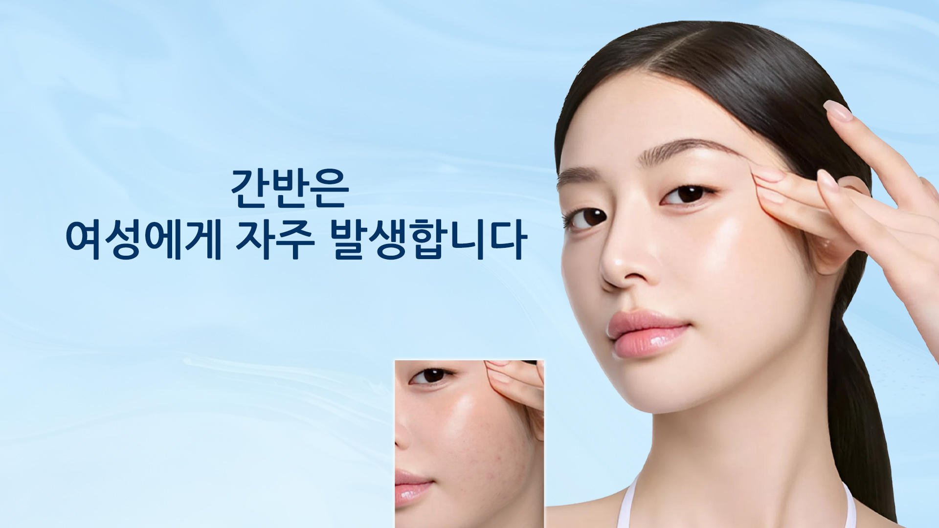 왜 기미가 여성에게 더 많이 발생하는가? 그리고 치료 방법